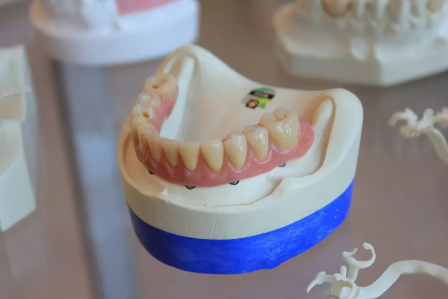 Những loại phục hình răng phổ biến trong nha khoa thẩm mỹ mà các kỹ thuật viên phục hình răng nên biết