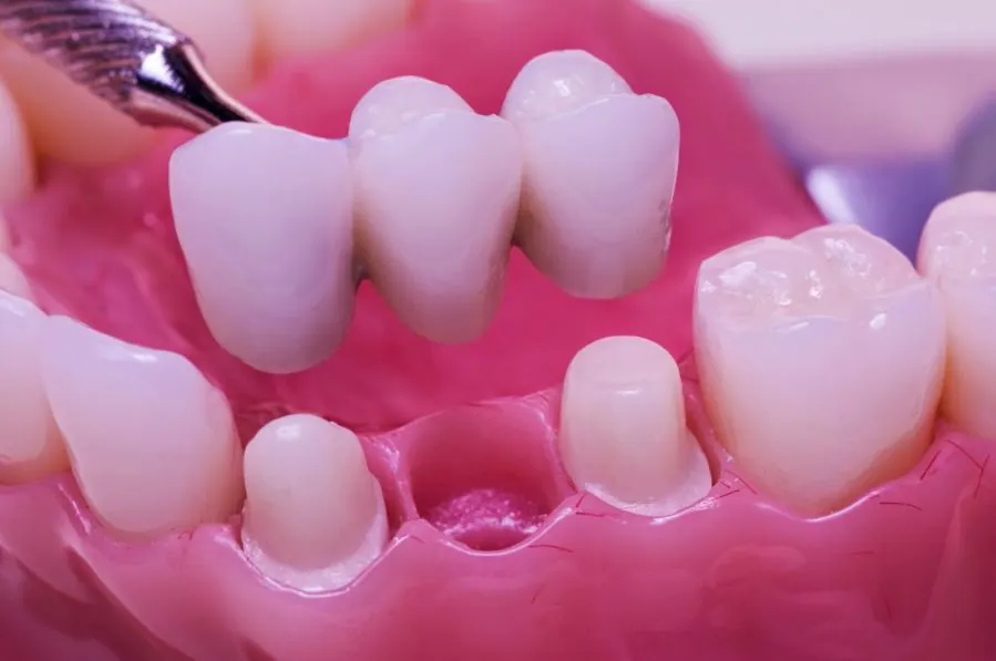 Những loại phục hình răng phổ biến trong nha khoa thẩm mỹ mà các kỹ thuật viên phục hình răng nên biết 8