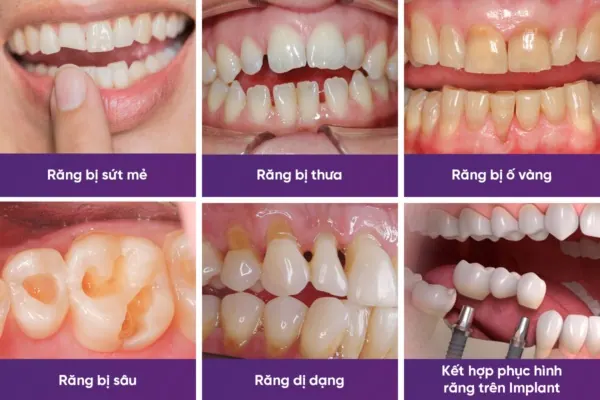 đối tượng bọc răng sứ