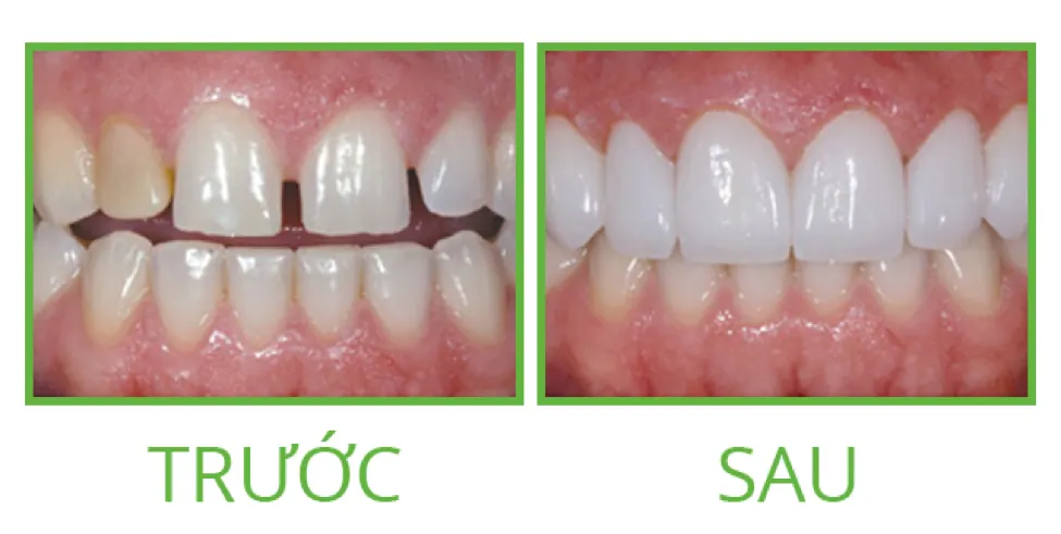 Răng Sứ Nacera Là Gì? Các Ưu Điểm Nổi Bật Của Răng Sứ Nacera - ảnh 2